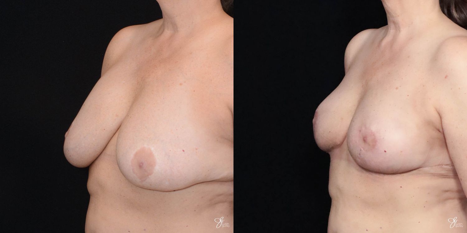 Implant Removal Replacement Before & After