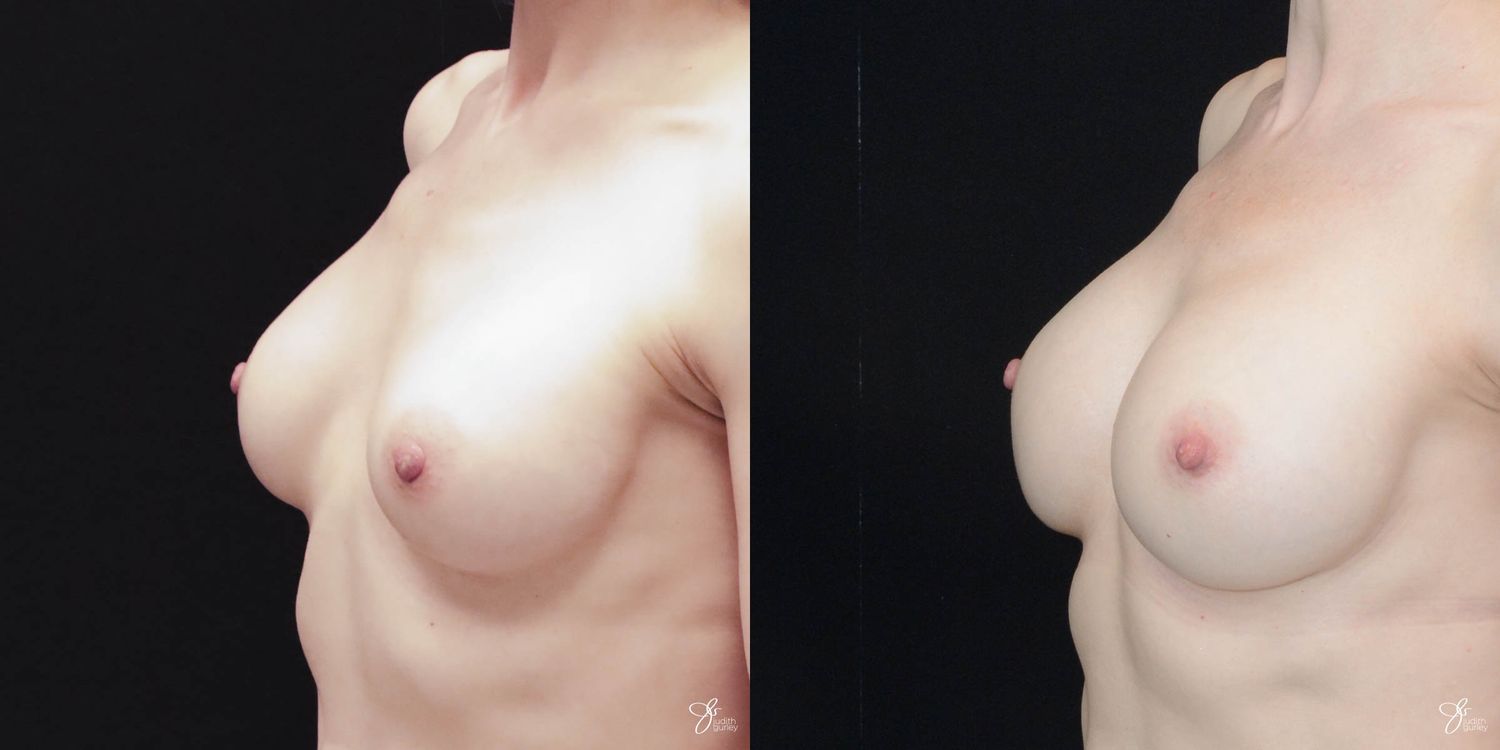 Implant Removal Replacement Before & After