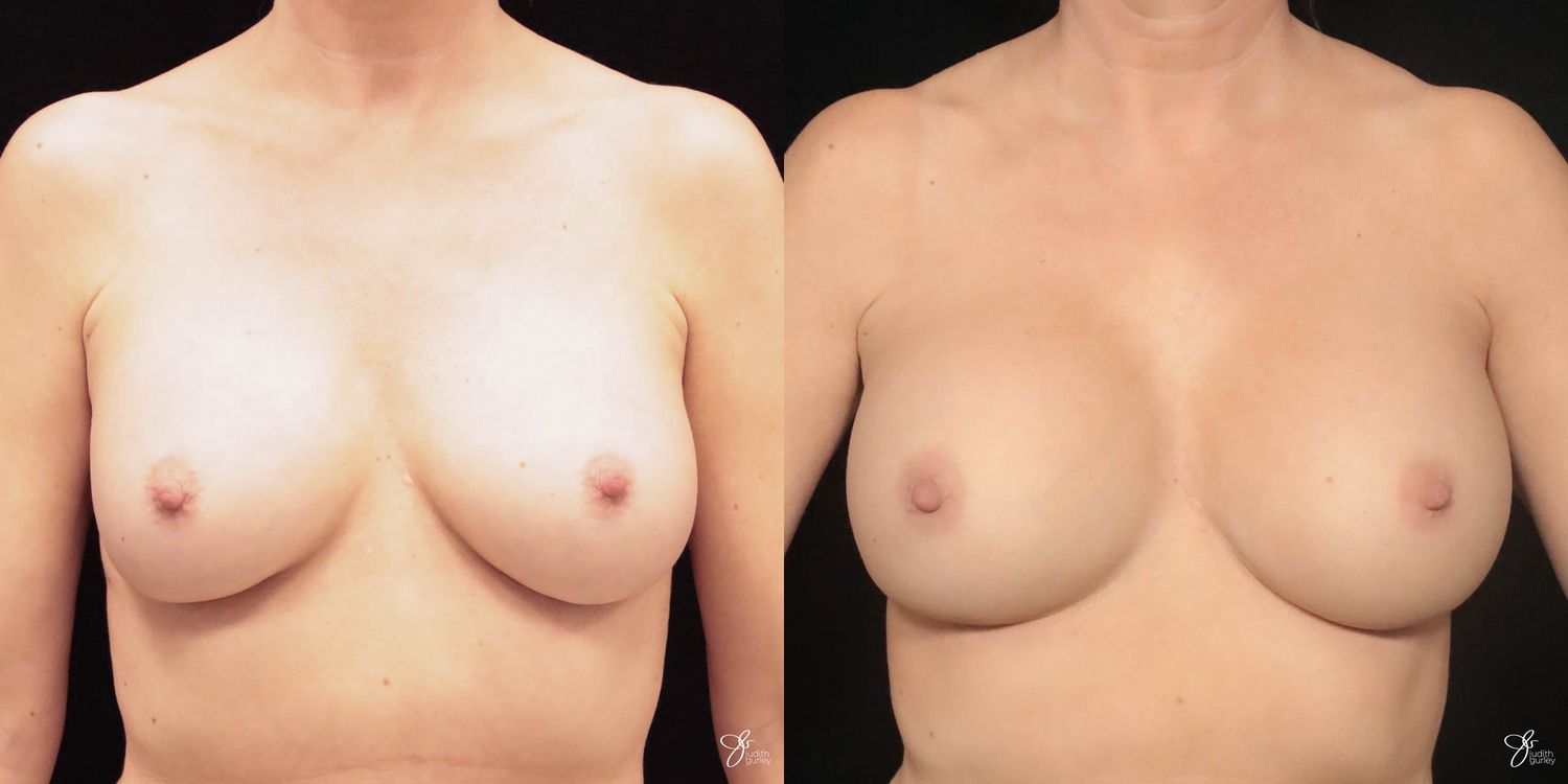 Implant Removal Replacement Before & After