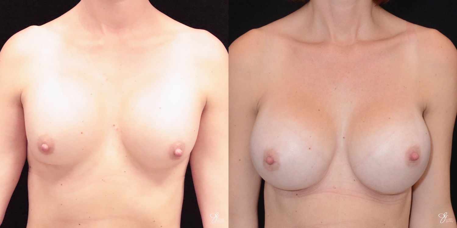 Implant Removal Replacement Before & After