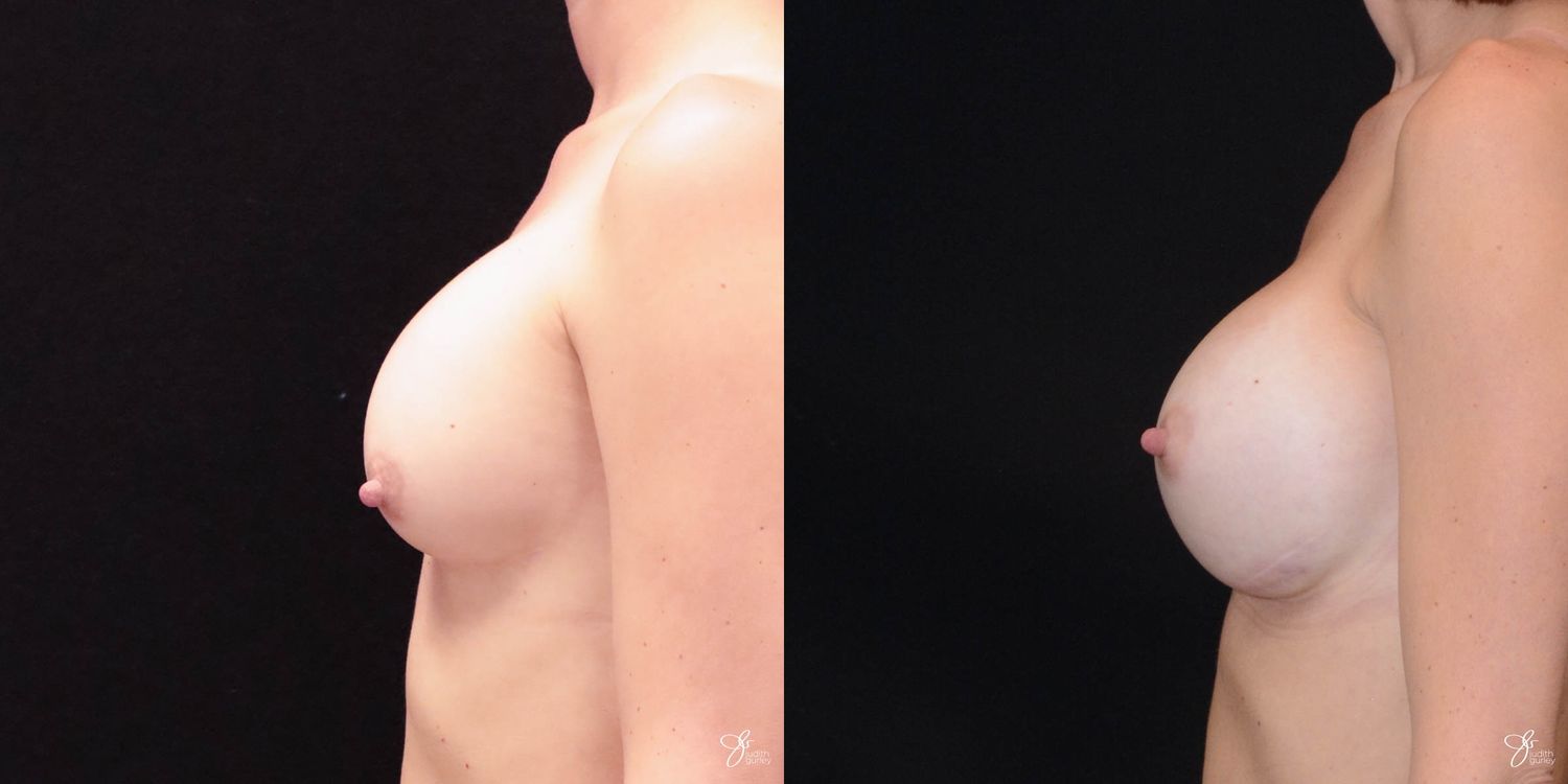 Implant Removal Replacement Before & After