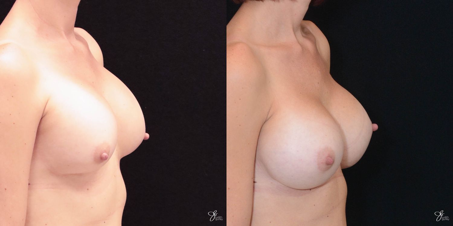 Implant Removal Replacement Before & After