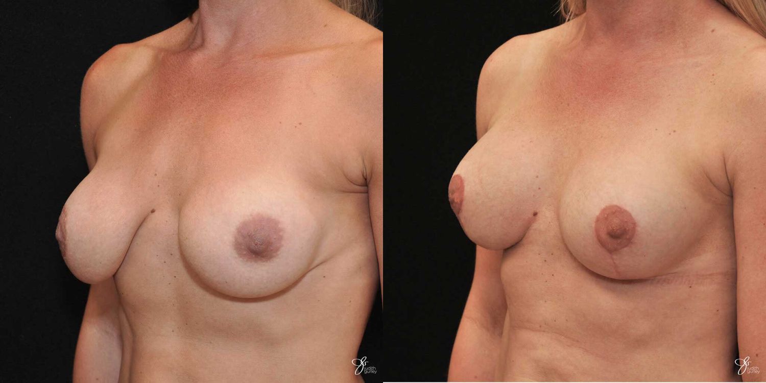 Implant Removal Replacement Before & After