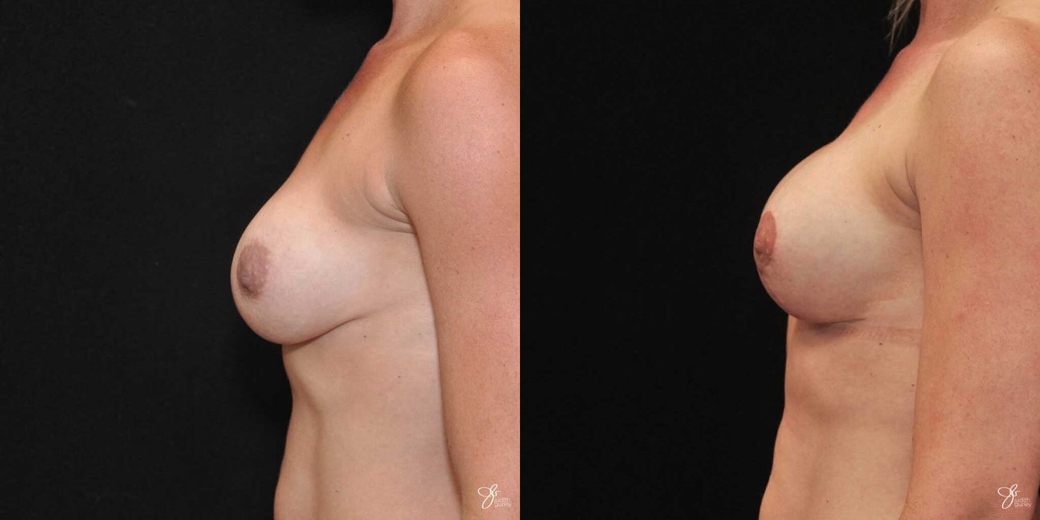 Implant Removal Replacement Before & After