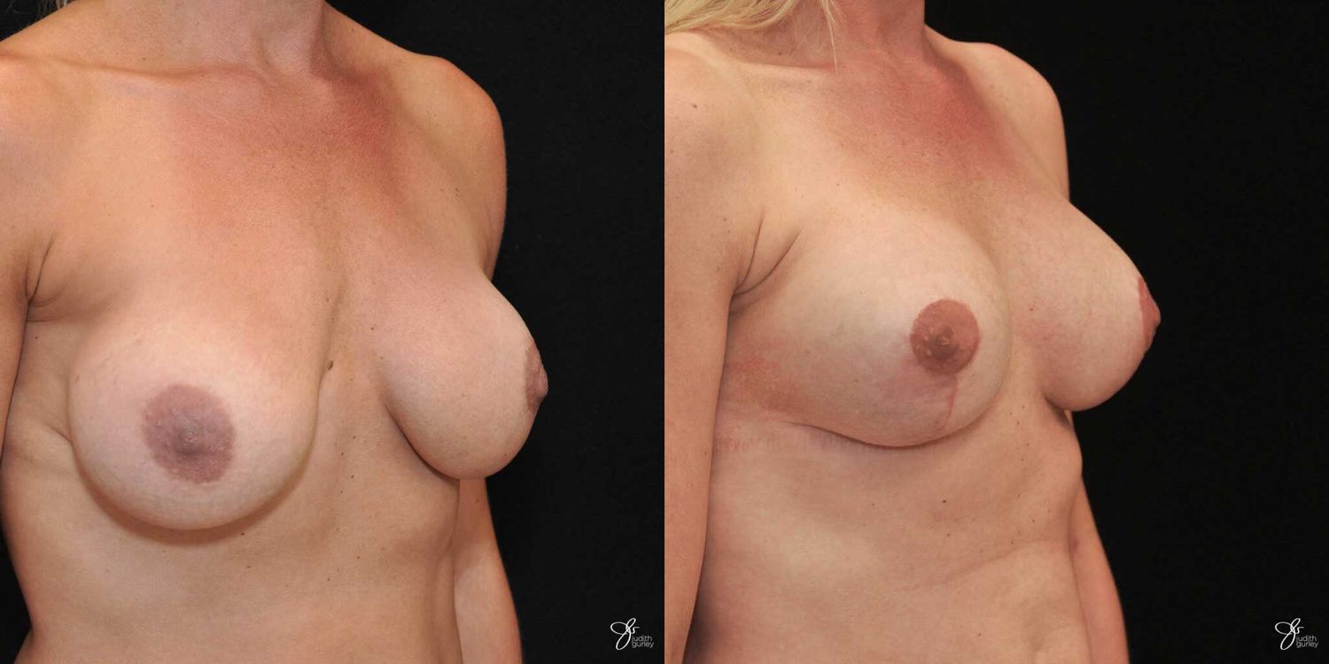 Implant Removal Replacement Before & After