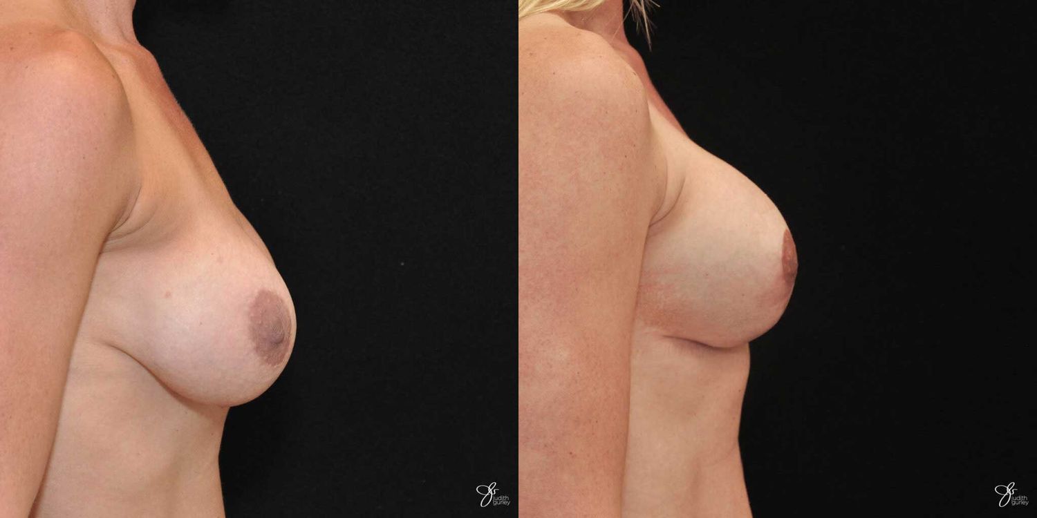 Implant Removal Replacement Before & After