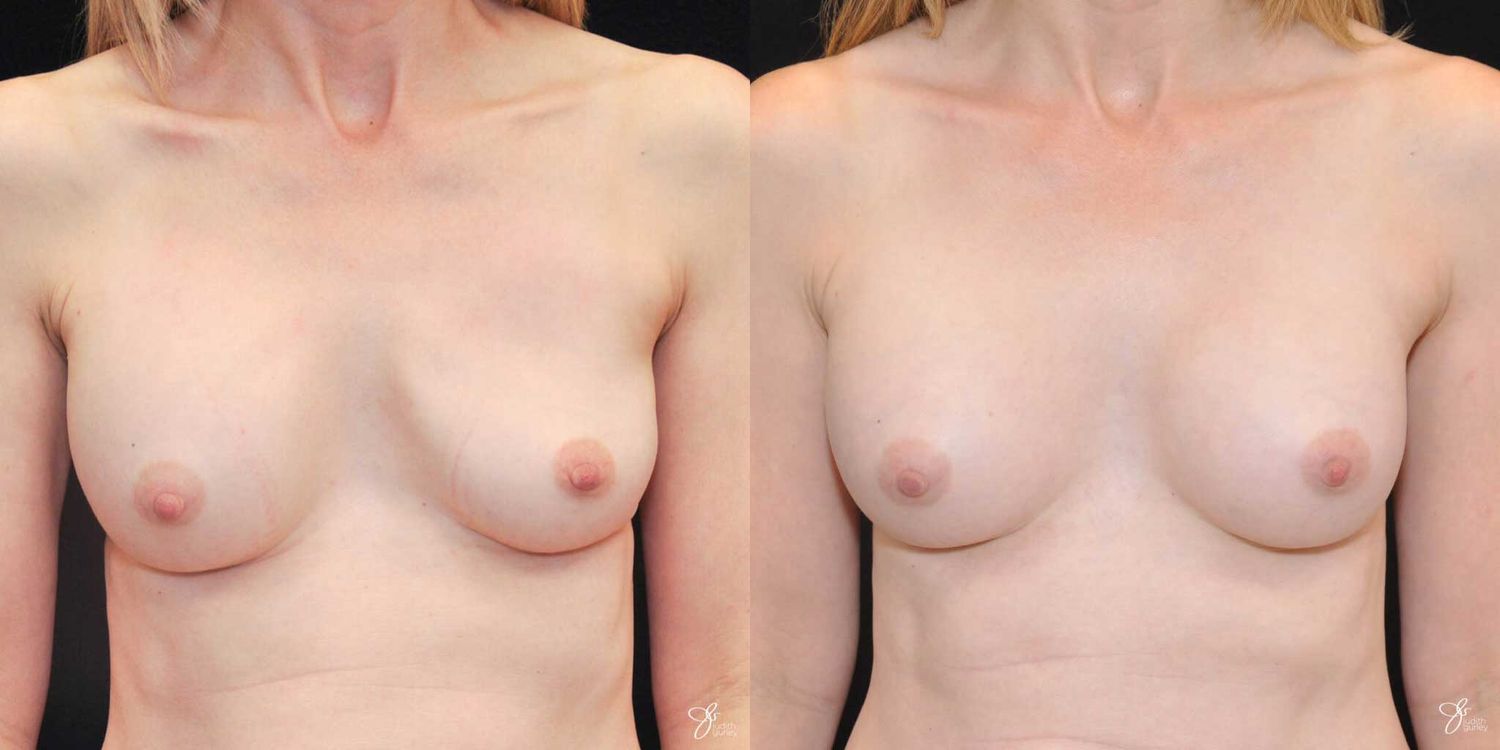 Implant Removal Replacement Before & After