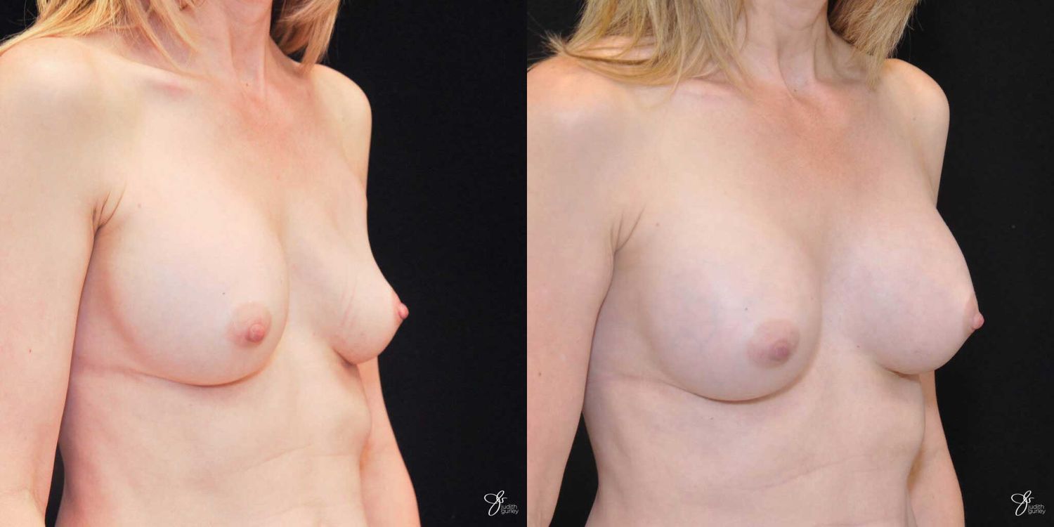 Implant Removal Replacement Before & After