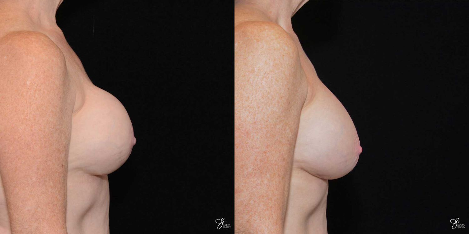 Implant Removal Replacement Before & After