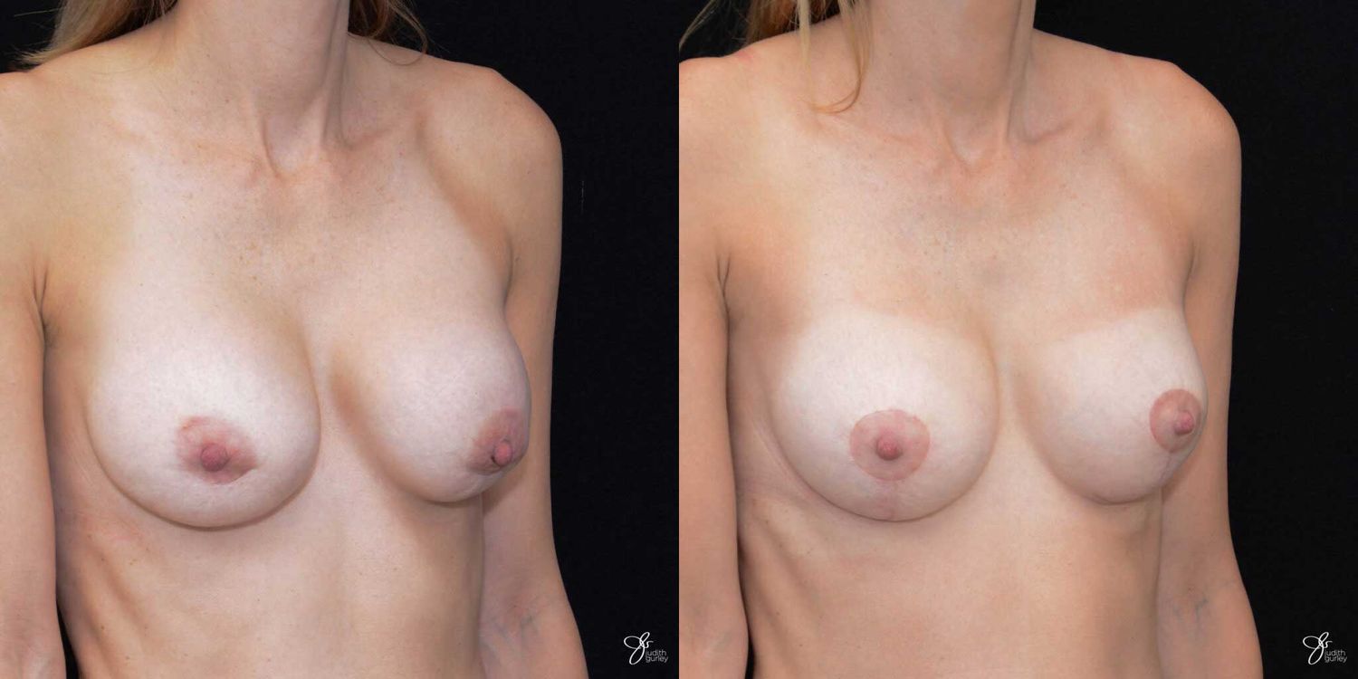 Implant Removal Replacement Before & After