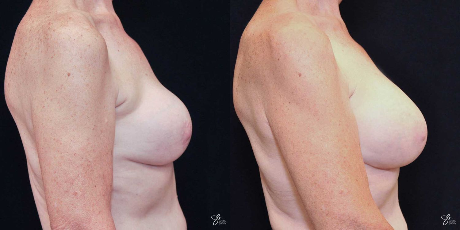 Implant Removal Replacement Before & After