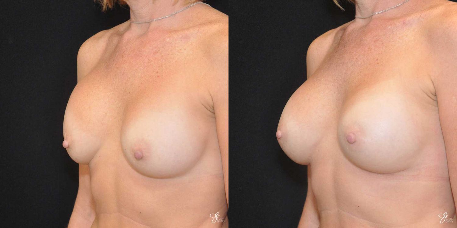 Implant Removal Replacement Before & After