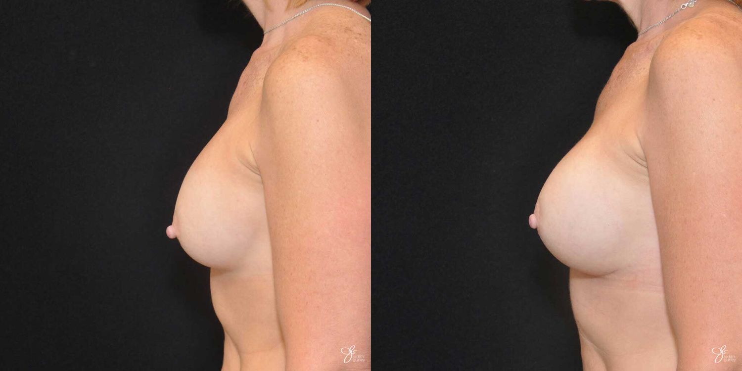 Implant Removal Replacement Before & After