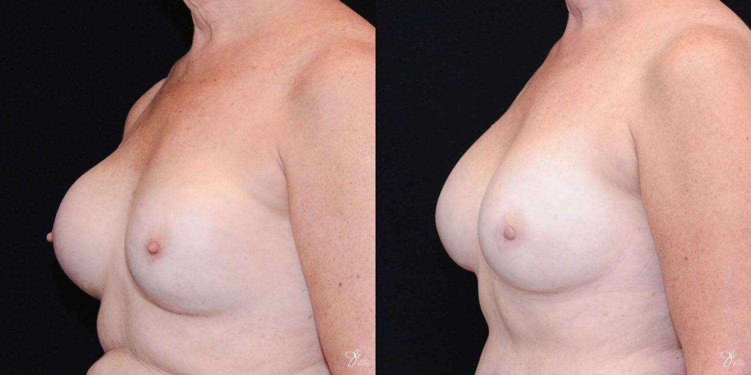 Implant Removal Replacement Before & After