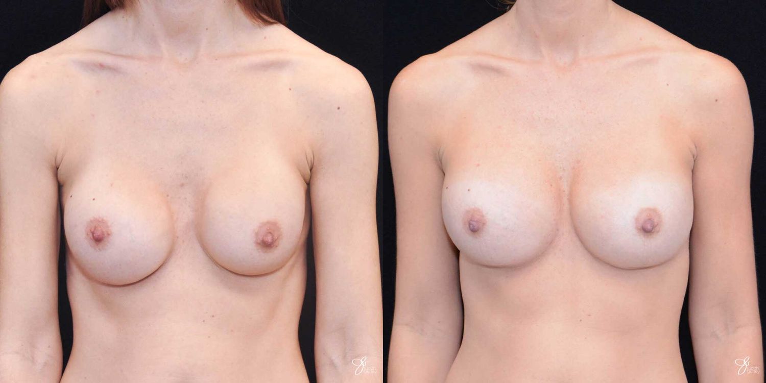 Implant Removal Replacement Before & After