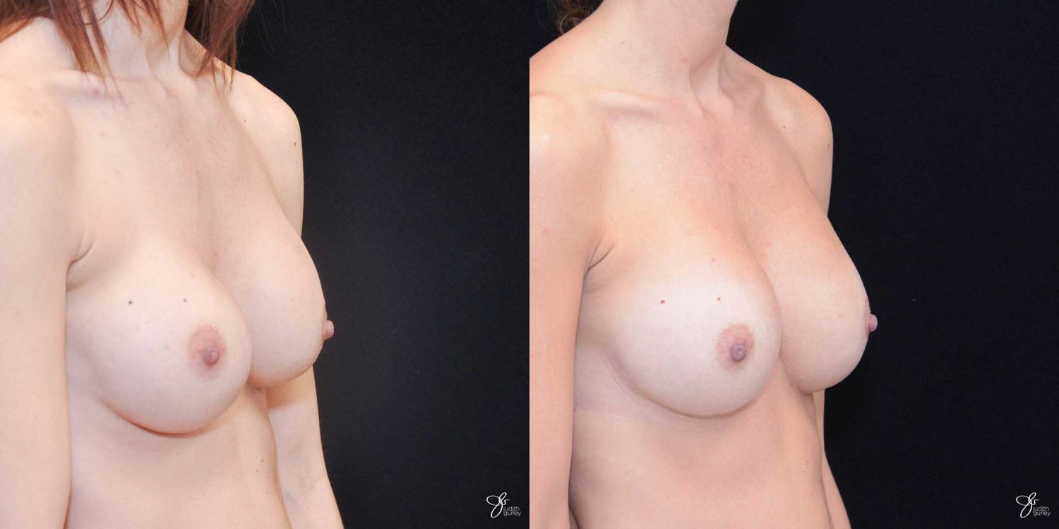 Implant Removal Replacement Before & After