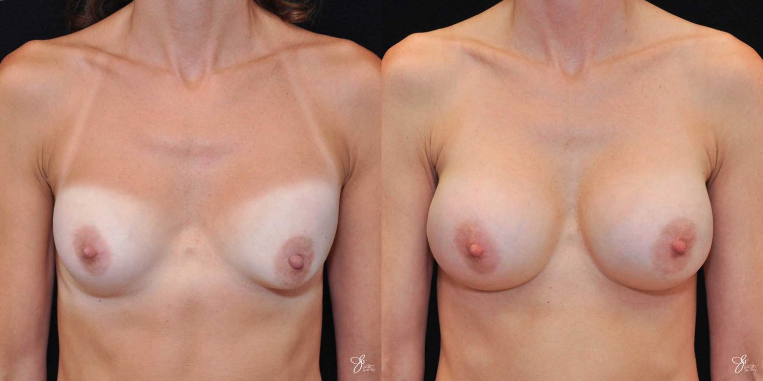 Implant Removal Replacement Before & After