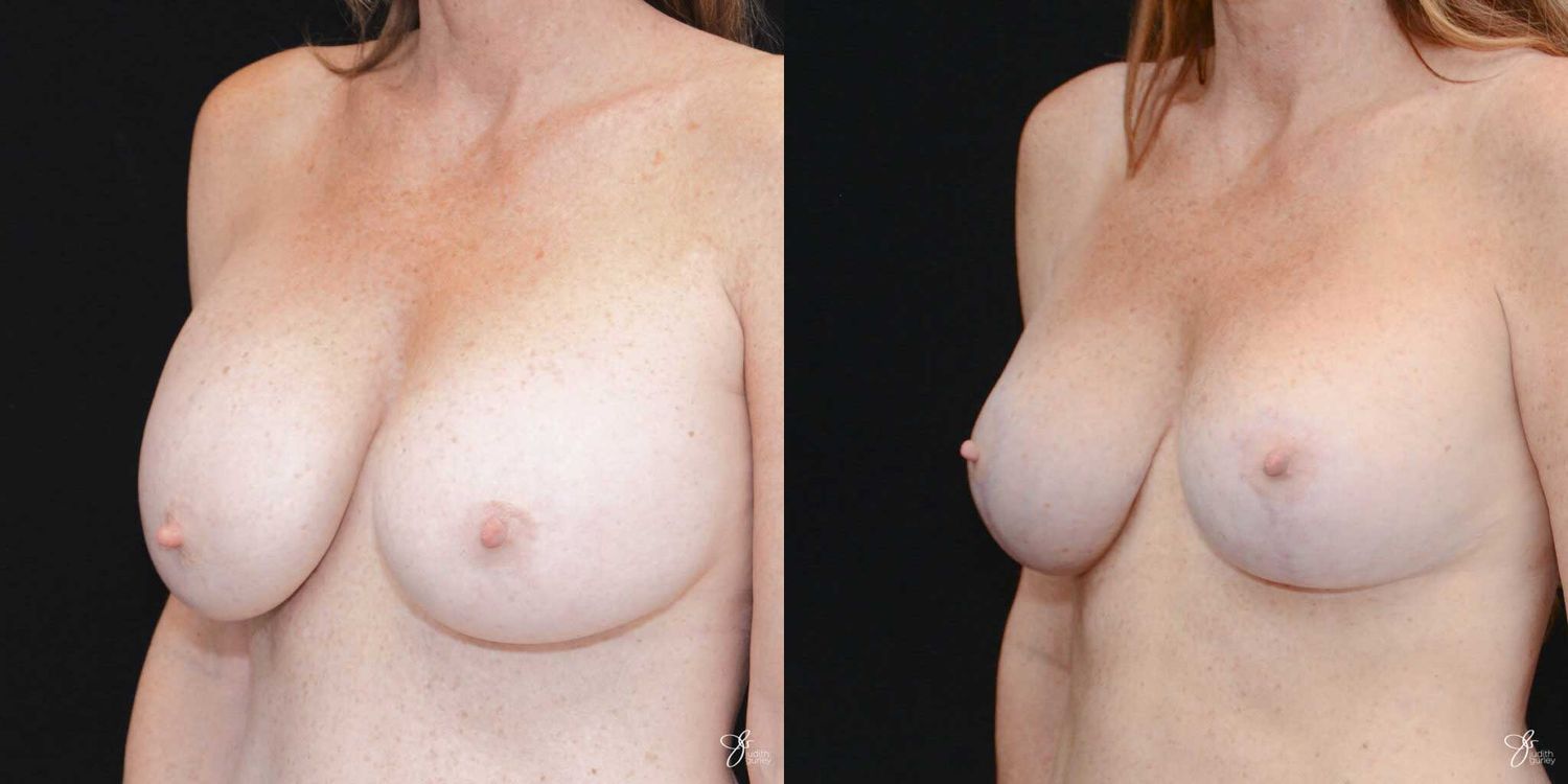 Implant Removal Replacement Before & After