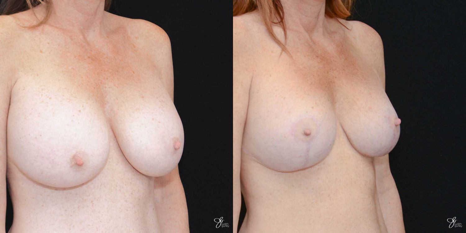 Implant Removal Replacement Before & After