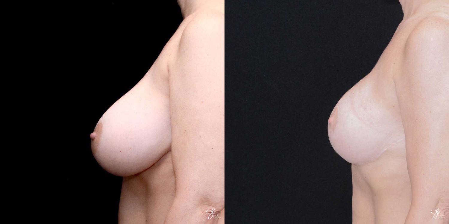 Implant Removal Replacement Before & After