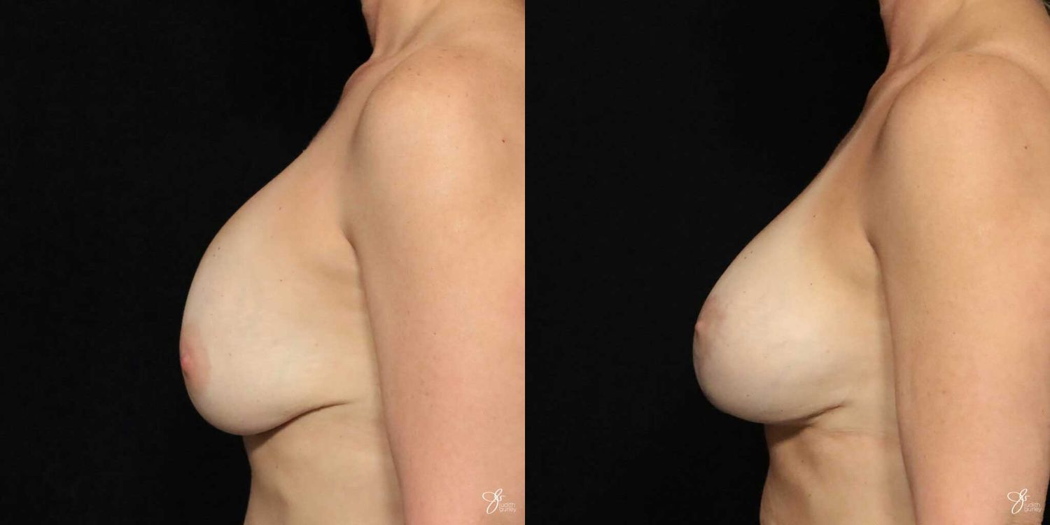 Implant Removal Replacement Before & After