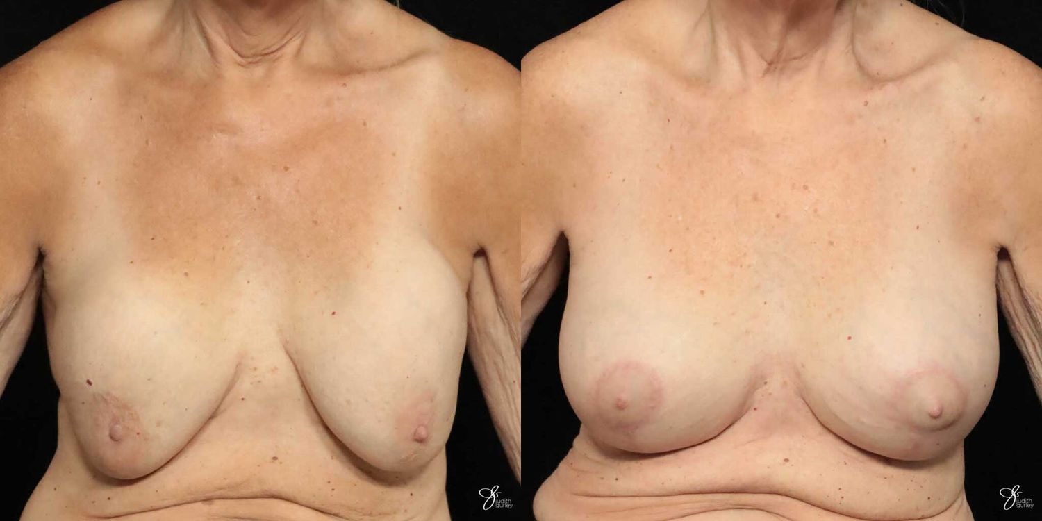 Implant Removal Replacement Before & After