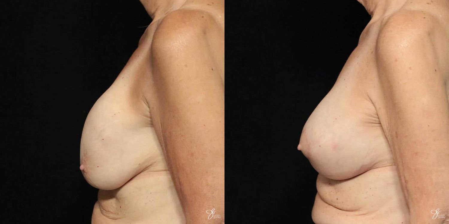 Implant Removal Replacement Before & After