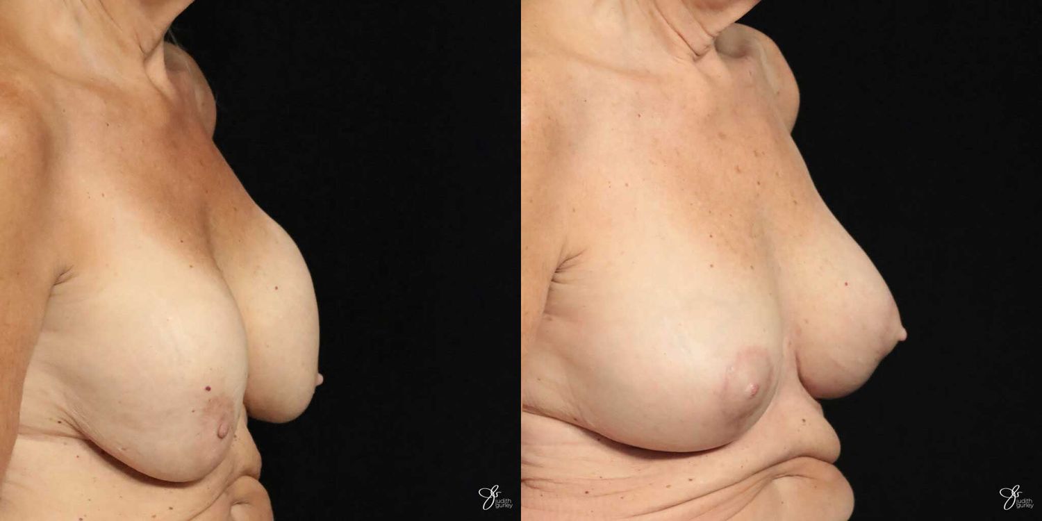 Implant Removal Replacement Before & After