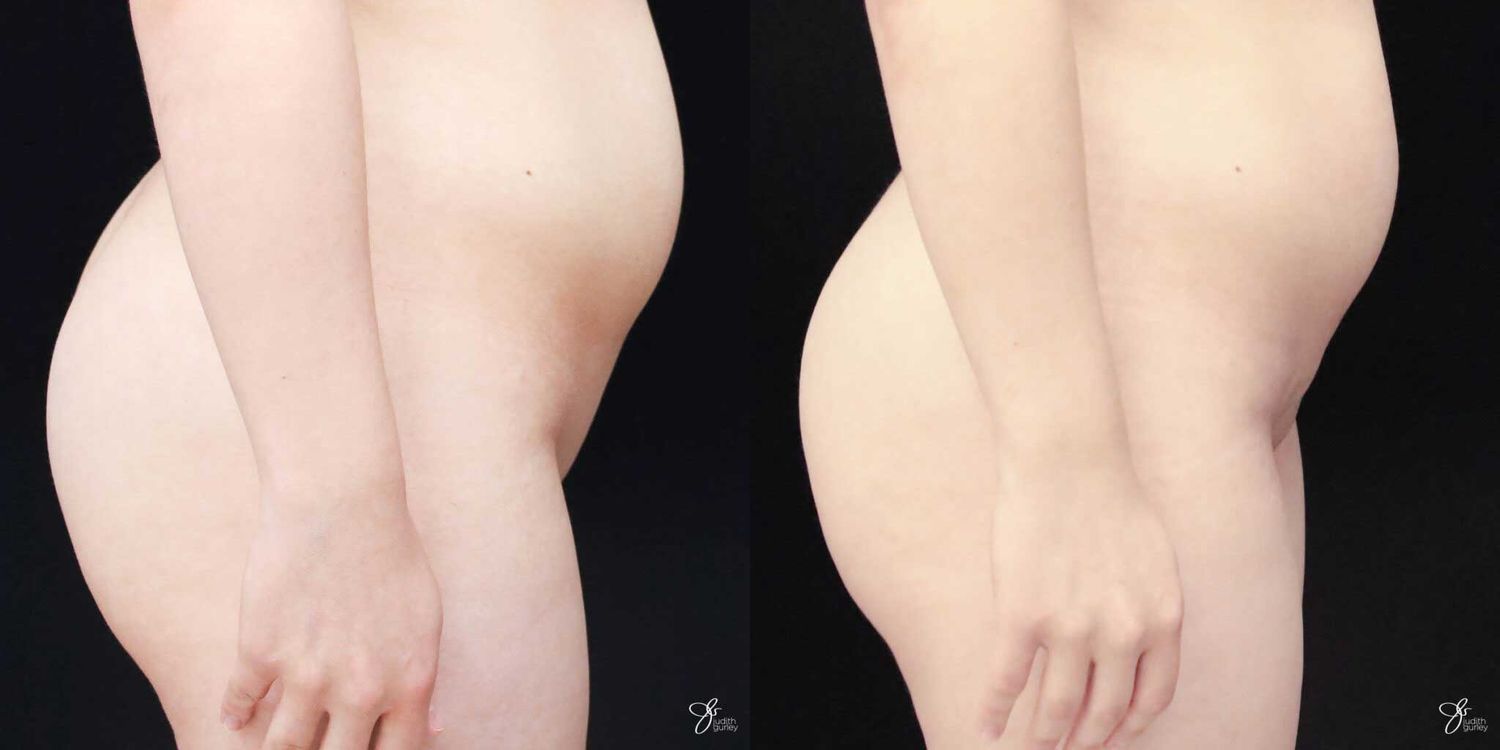 Monsplasty Fupa Reduction Before & After