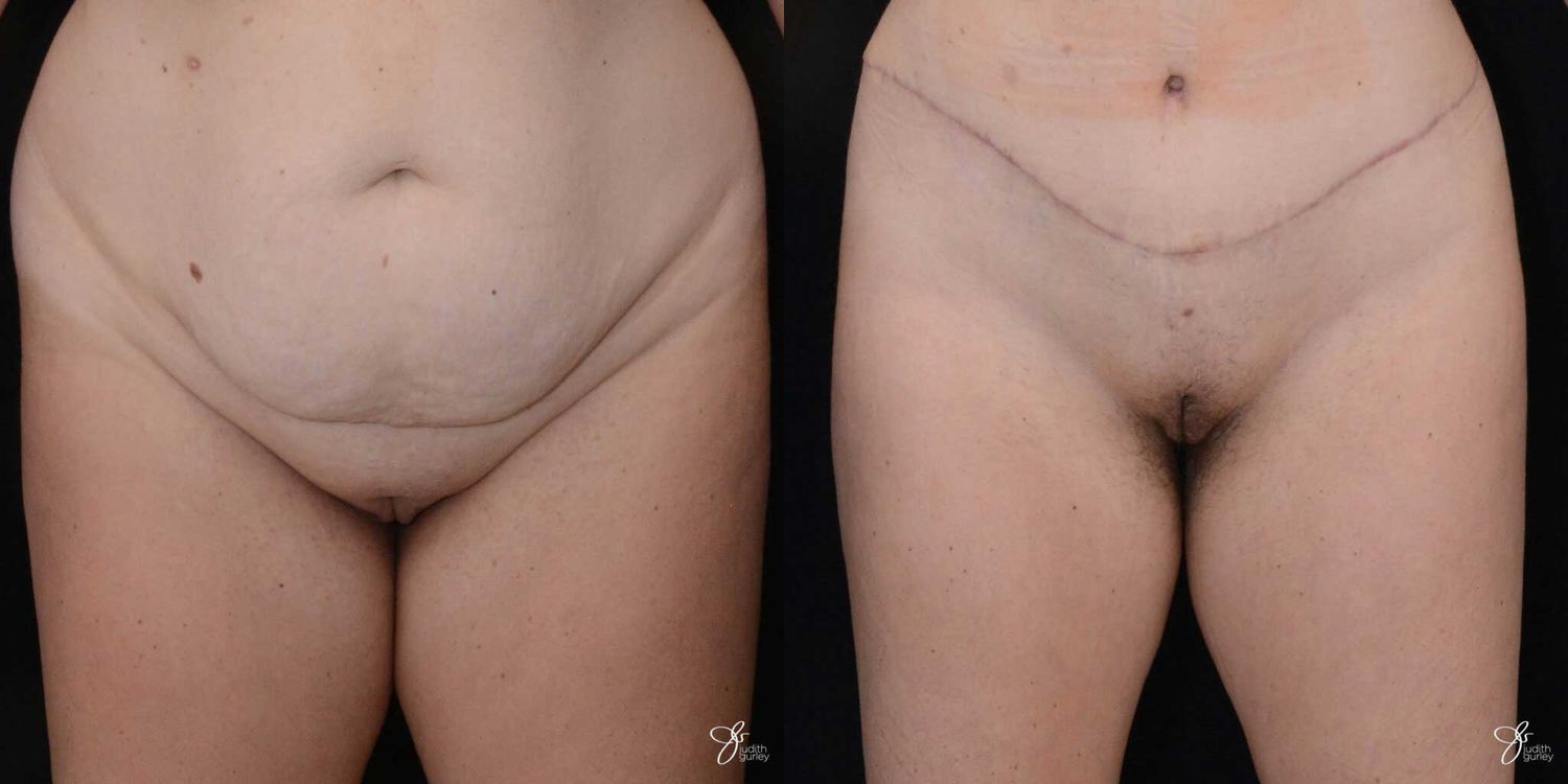 Monsplasty Fupa Reduction Before & After
