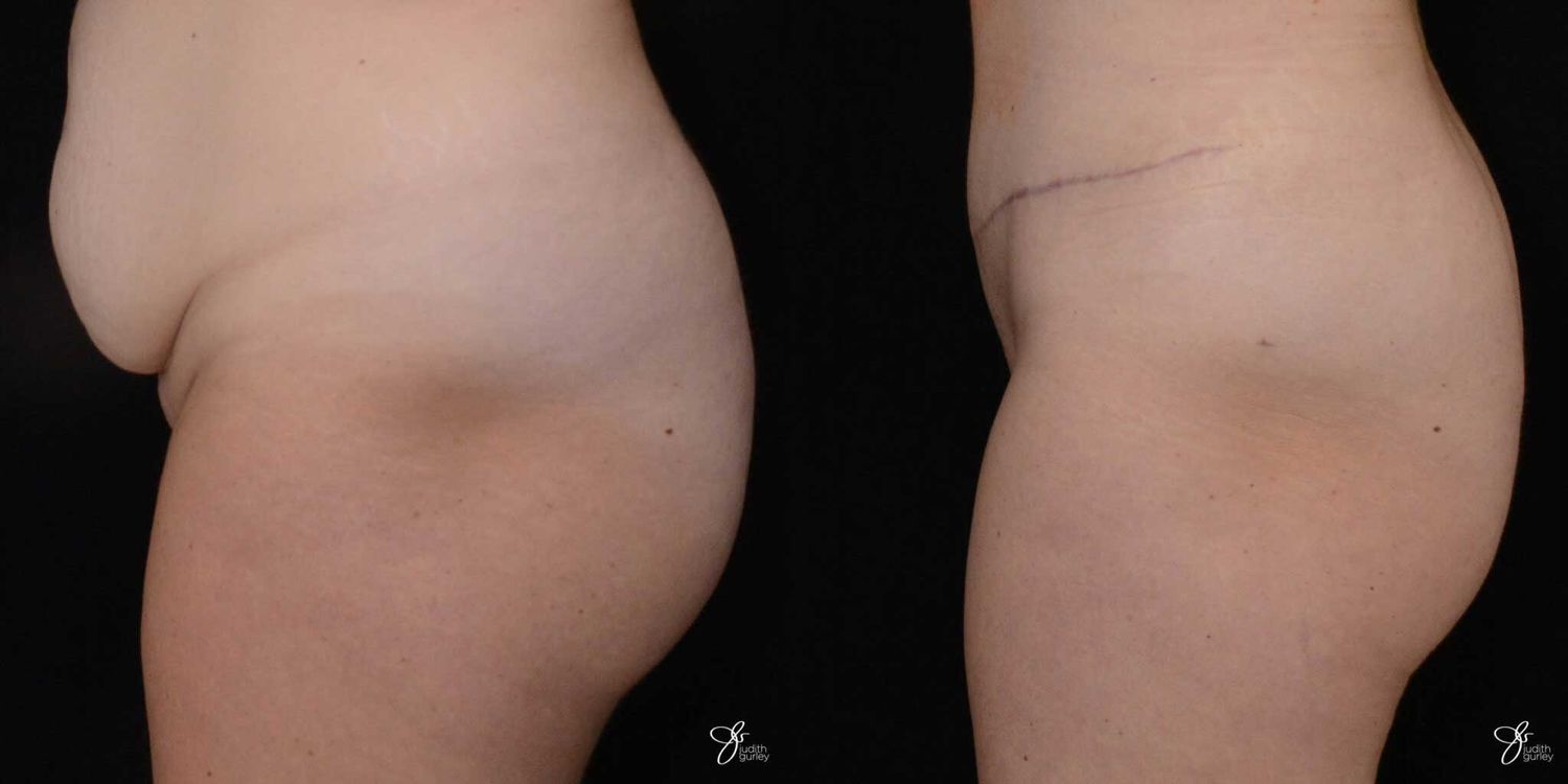 Monsplasty Fupa Reduction Before & After