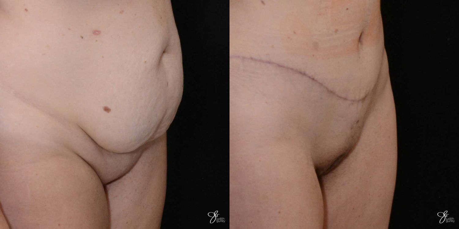 Monsplasty Fupa Reduction Before & After