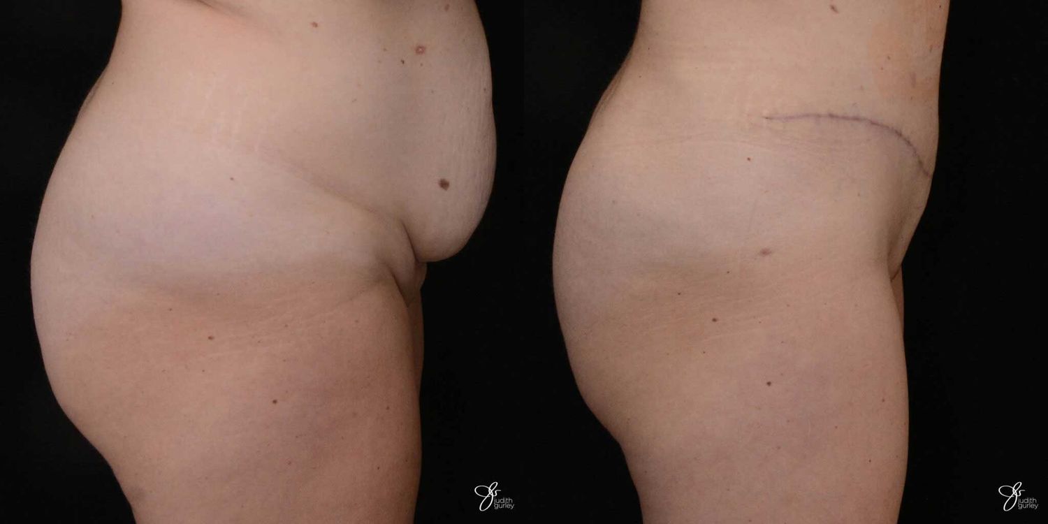 Monsplasty Fupa Reduction Before & After