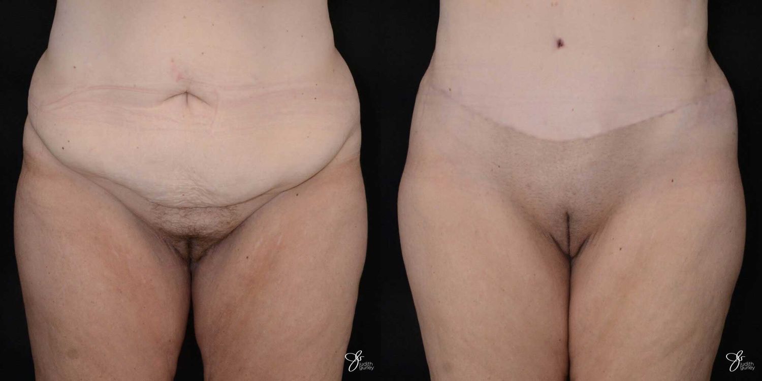 Monsplasty Fupa Reduction Before & After