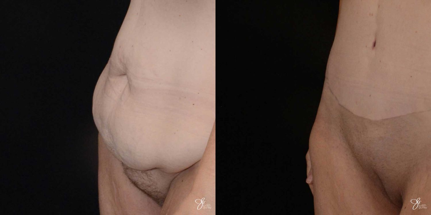 Monsplasty Fupa Reduction Before & After
