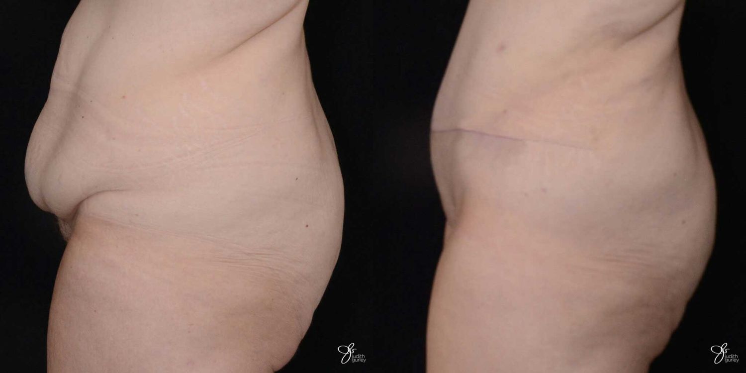 Monsplasty Fupa Reduction Before & After