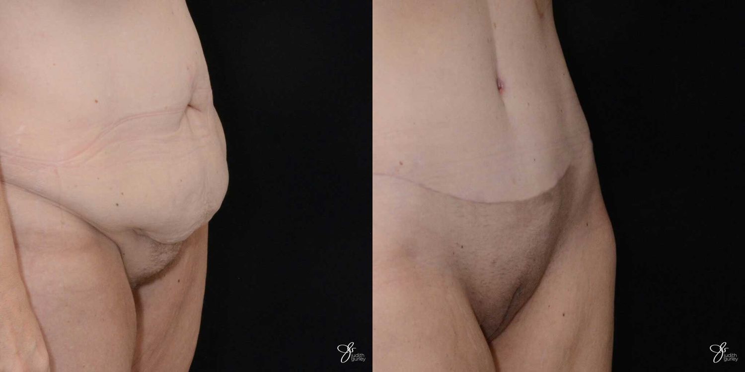 Monsplasty Fupa Reduction Before & After