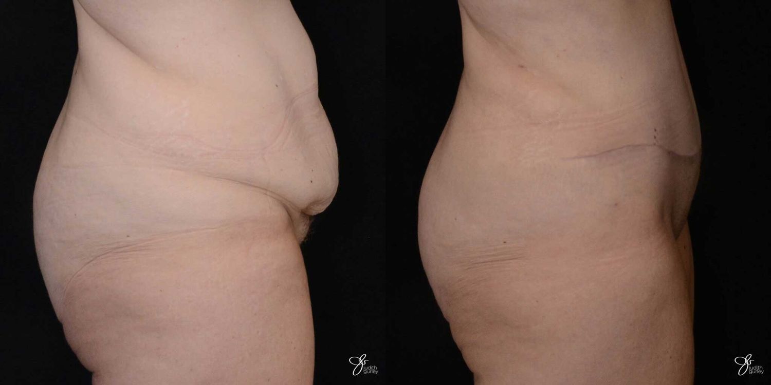 Monsplasty Fupa Reduction Before & After