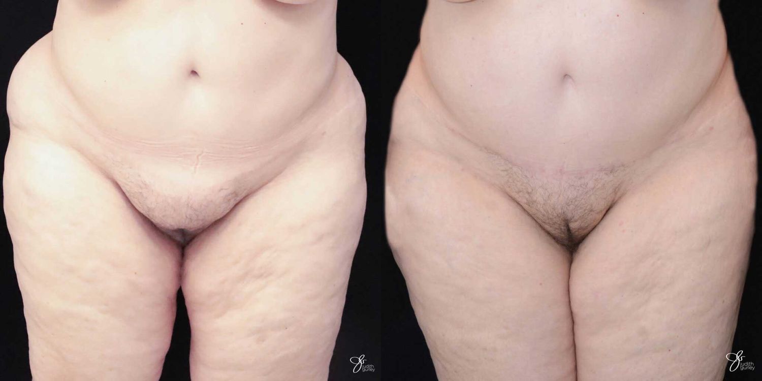 Monsplasty Fupa Reduction Before & After