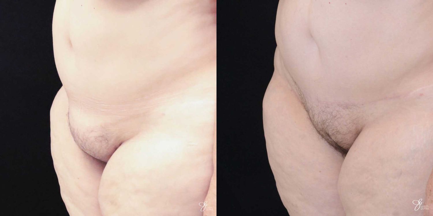 Monsplasty Fupa Reduction Before & After