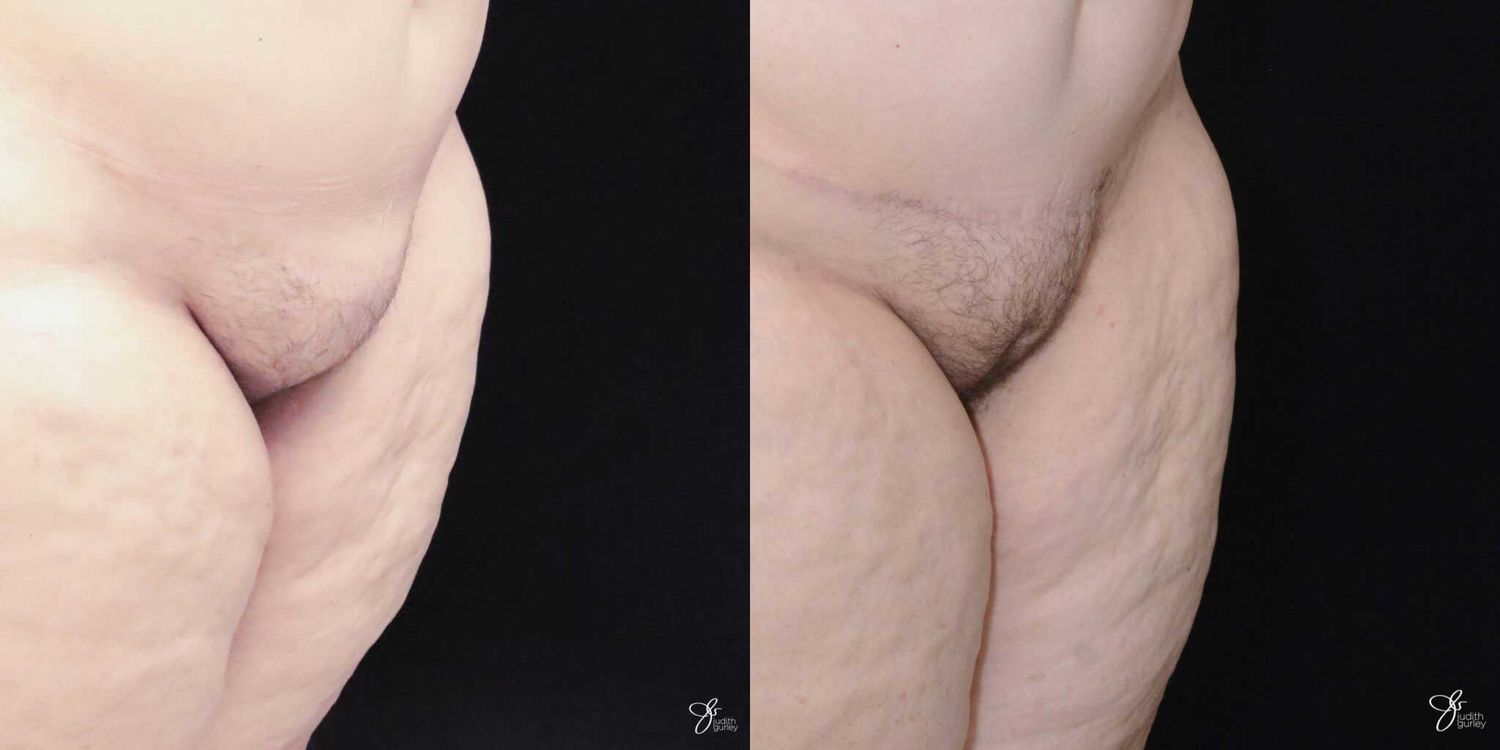 Monsplasty Fupa Reduction Before & After