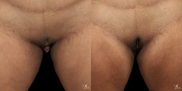Labiaplasty Before & After