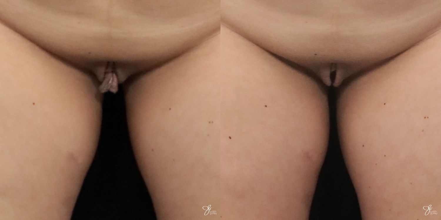 Labiaplasty Before & After