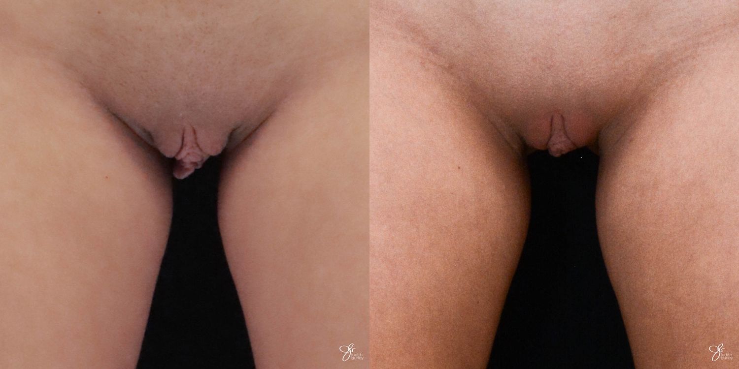 Labiaplasty Before & After