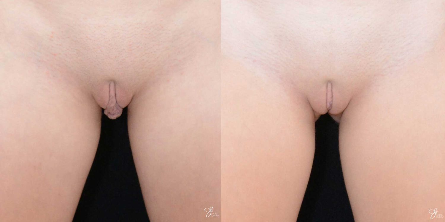 Labiaplasty Before & After