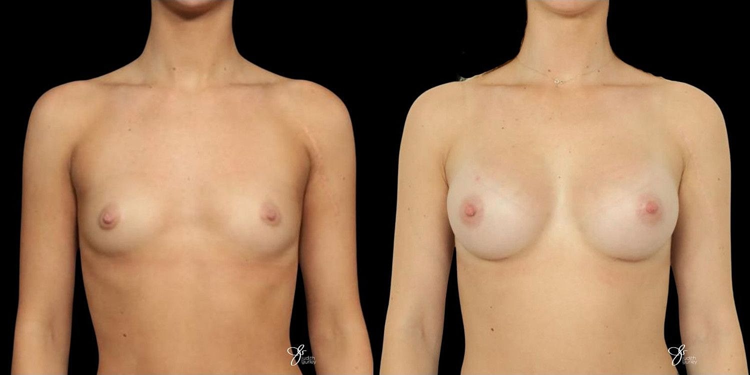 Motiva Breast Implants Before & After