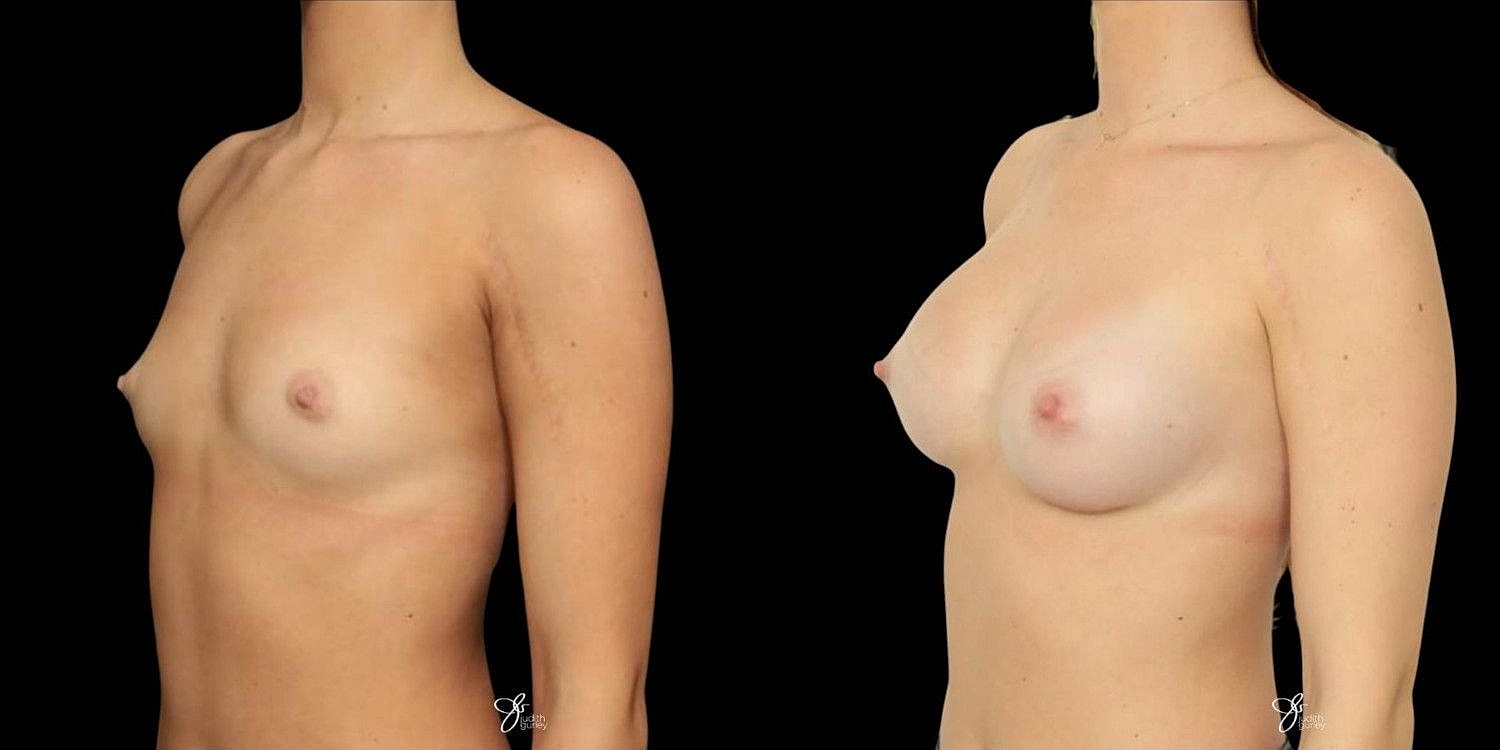 Motiva Breast Implants Before & After