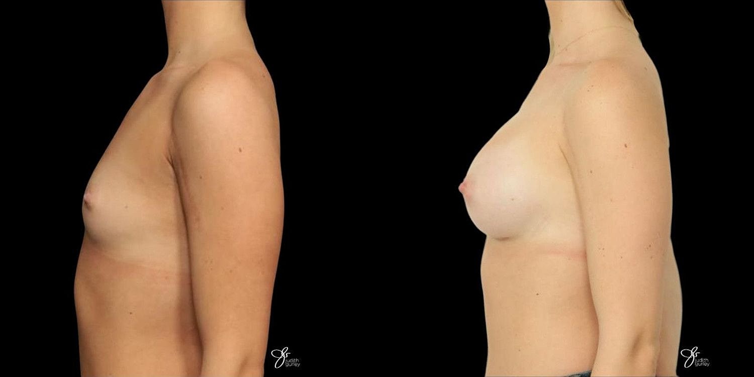 Motiva Breast Implants Before & After