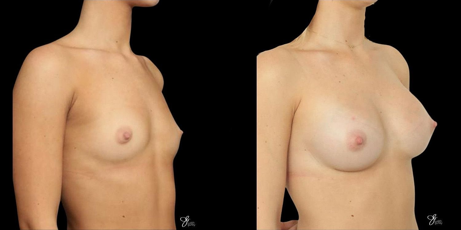 Motiva Breast Implants Before & After