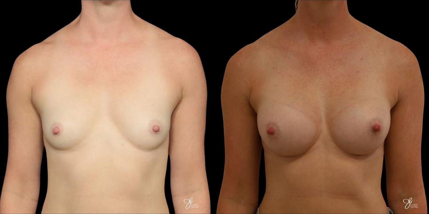 Motiva Breast Implants Before & After